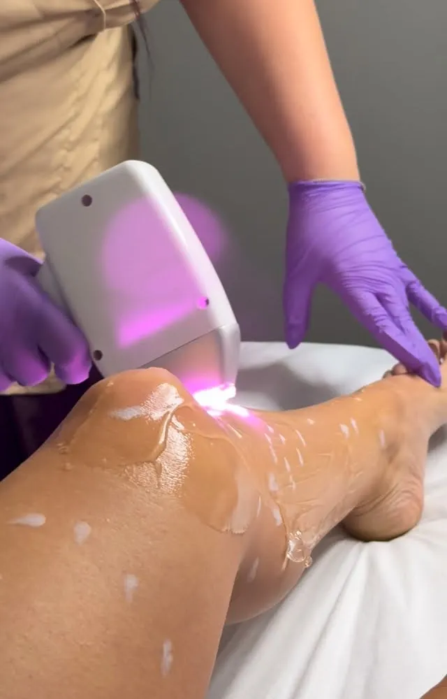 Epilare definitivă cu laser pe picioare, tratament profesional Before & After Timișoara